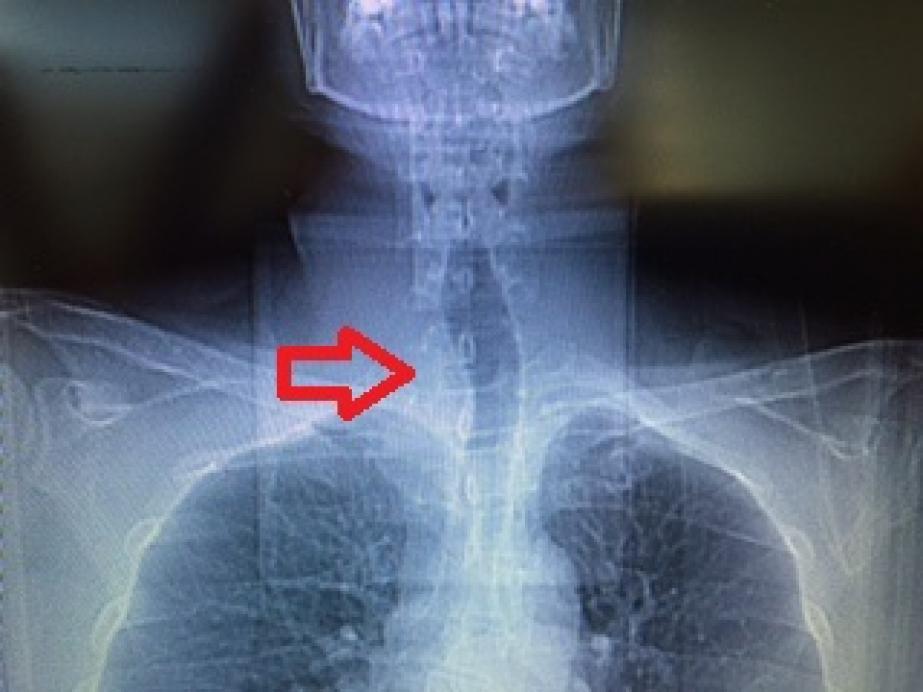 Guatr soluk borusunu itmiş