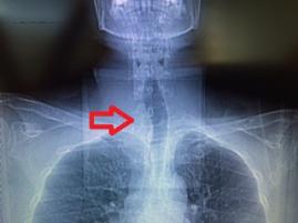 Guatr soluk borusunu itmiş