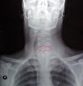 Guatr soluk borusunu itmiş