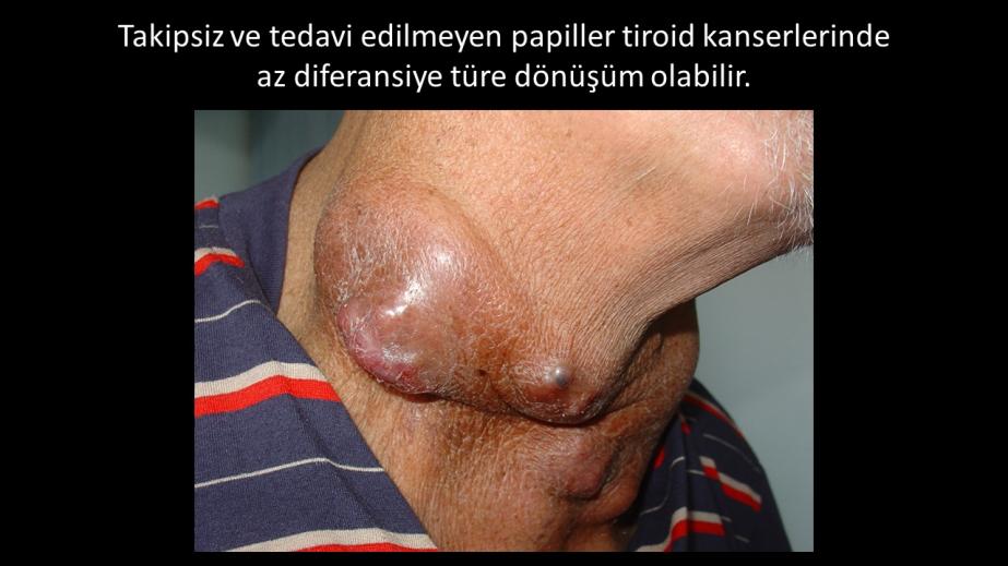 Papiller tiroid kanserinin az diferansiye kansere dönüşümü