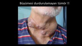 Papiller tiroid kanserinin az diferansiye kansere dönüşümü