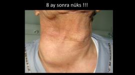 Papiller tiroid kanserinin az diferansiye kansere dönüşümü