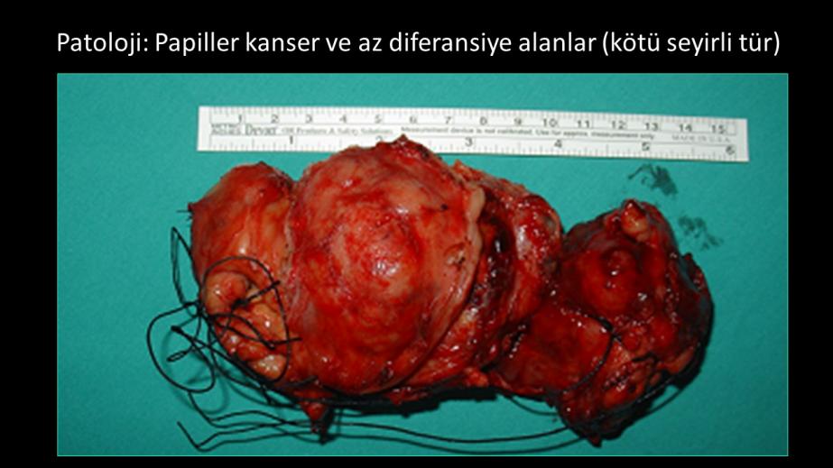 Papiller tiroid kanserinin az diferansiye kansere dönüşümü