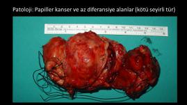Papiller tiroid kanserinin az diferansiye kansere dönüşümü
