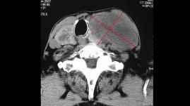 Papiller tiroid kanserinin az diferansiye kansere dönüşümü