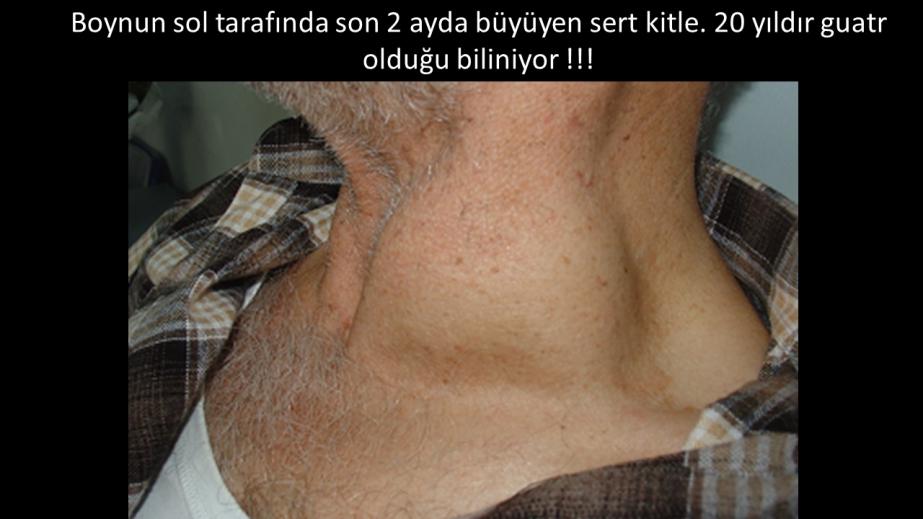 Papiller tiroid kanserinin az diferansiye kansere dönüşümü