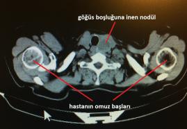 Plonjan guatr (İç Guatr)