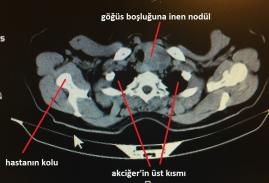 Plonjan guatr (İç Guatr)