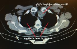 Plonjan guatr (İç Guatr)
