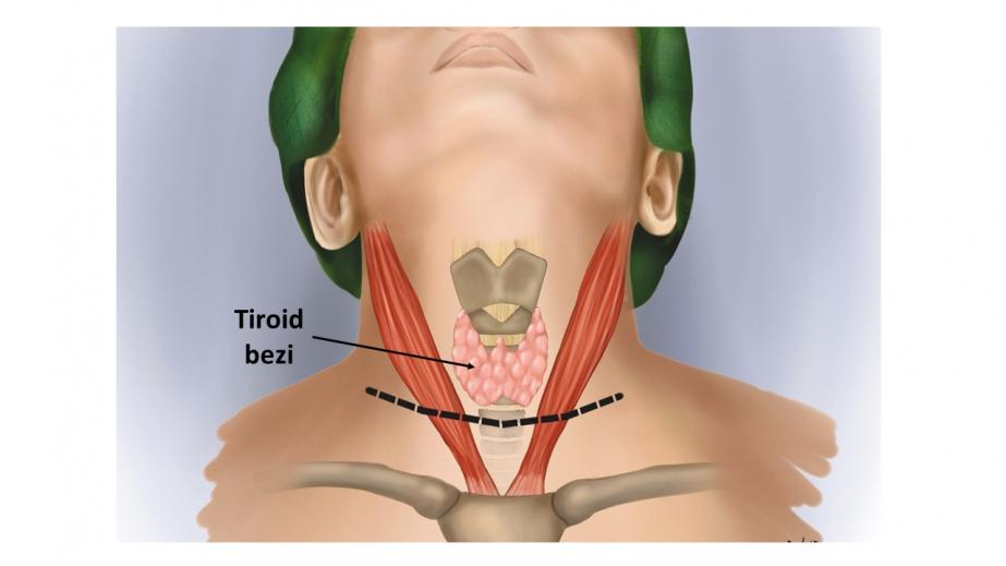 Tiroid anatomisi ile ilgili şematik resimler
